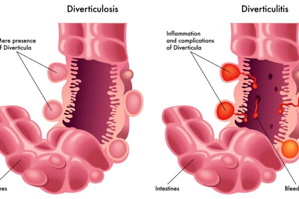 Image of intestines with diverticulitis