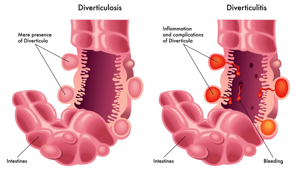 Image of intestines with diverticulitis