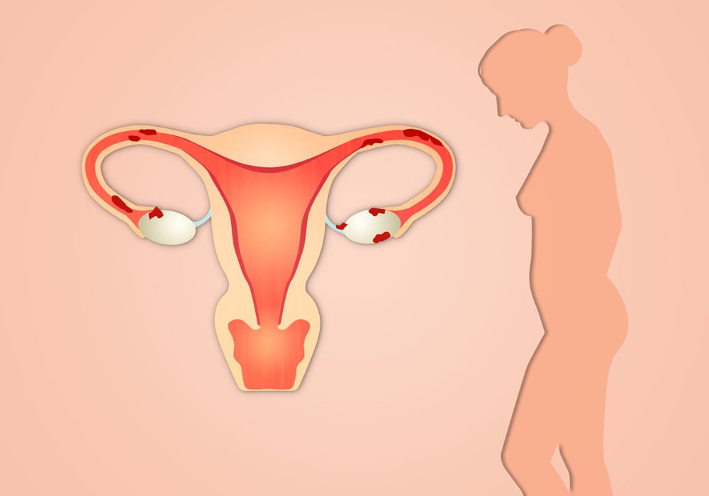 Diagram of a woman and uterus with endometriosis